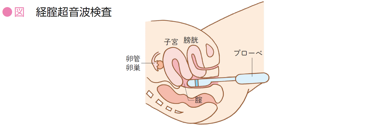 経膣超音波卵巣がん